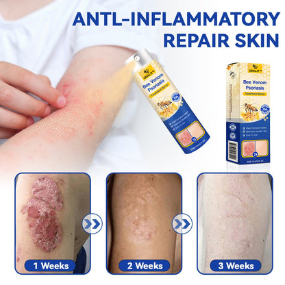 ODALIT™ PsoriaHeal Bee Venom Psoriasis Treatment Spray pro