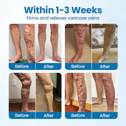 Nexisify® VeinGuard Herbal Spray-✅ Clinically proven to eliminate varicose veins in just 7 days!