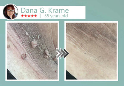 🔥Final 3 Hours: 80% OFF - LBMLBM® MicroNeedle Botanic Skin Tag Removal Patch 🇺🇸 Made in the USA