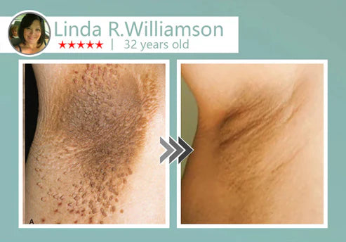 🔥Final 3 Hours: 80% OFF - LBMLBM® MicroNeedle Botanic Skin Tag Removal Patch 🇺🇸 Made in the USA