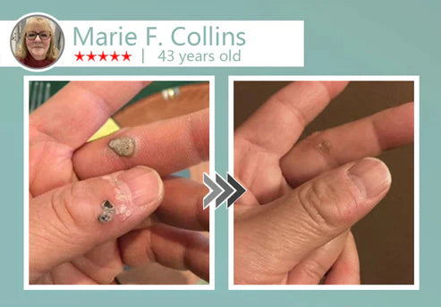 🔥Final 3 Hours: 80% OFF - LBMLBM® MicroNeedle Botanic Skin Tag Removal Patch 🇺🇸 Made in the USA