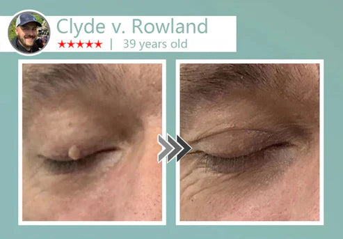 🔥Final 3 Hours: 80% OFF - LBMLBM® MicroNeedle Botanic Skin Tag Removal Patch 🇺🇸 Made in the USA