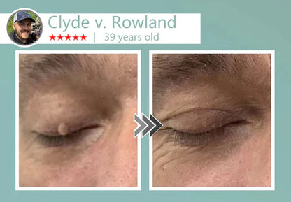 🔥Final 3 Hours: 80% OFF - LBMLBM® MicroNeedle Botanic Skin Tag Removal Patch 🇺🇸 Made in the USA