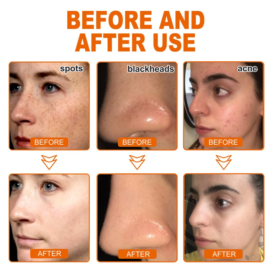 🌸[Official Brand Store] BBOJI™ Herbal Spots Peel-Off Facial Mask