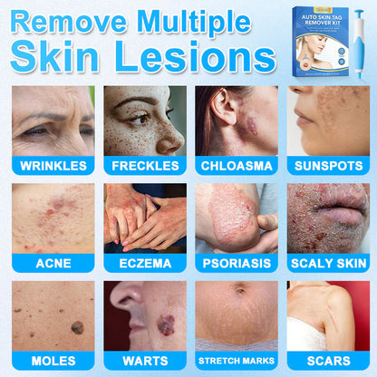 🔥MicroNeedle Botanic Skin Tag Removal kit 🇺🇸 Made in the USA👨‍⚕️