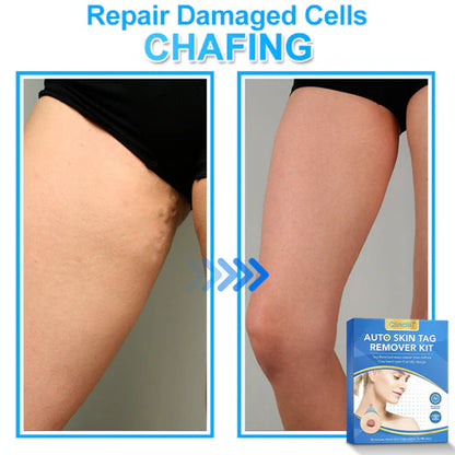 🔥MicroNeedle Botanic Skin Tag Removal kit 🇺🇸 Made in the USA👨‍⚕️