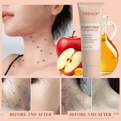 NEENCE® Purifying Exfoliating Gel for Acanthosis Nigricans, Exfoliation, Dark Spots, Skin Tags, and Eczema_Ultra01