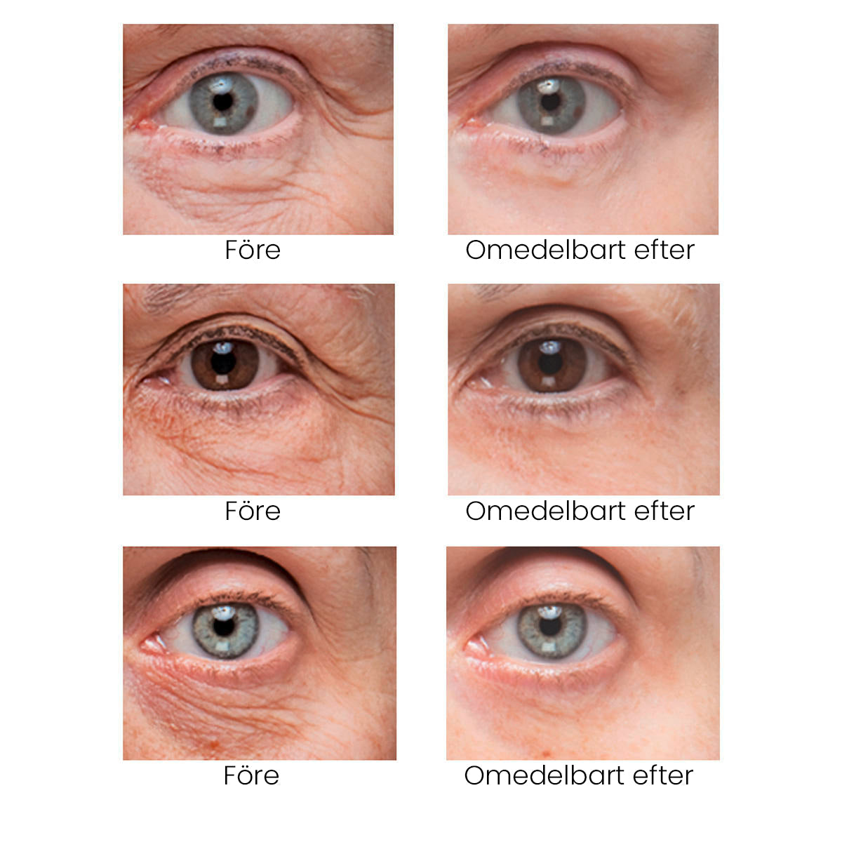 🔥Last 3 hours discount:BrightUp - Omedelbar Eye Tightener