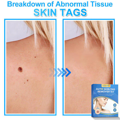 🔥MicroNeedle Botanic Skin Tag Removal kit 🇺🇸 Made in the USA👨‍⚕️