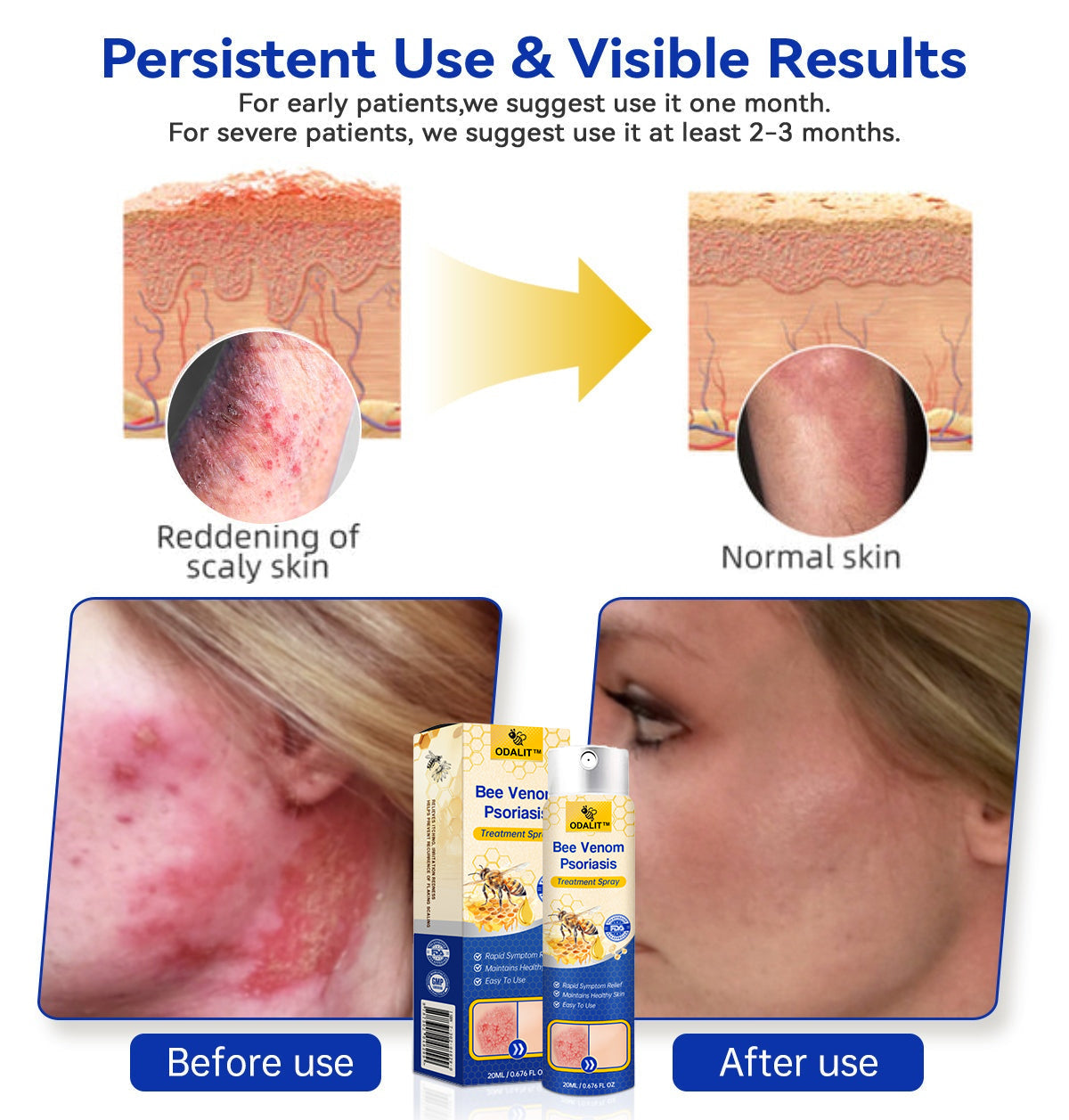 ODALIT™ PsoriaHeal Bee Venom Psoriasis Treatment Spray pro
