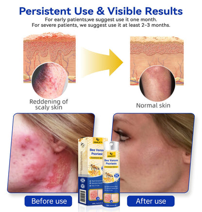 ODALIT™ PsoriaHeal Bee Venom Psoriasis Treatment Spray pro
