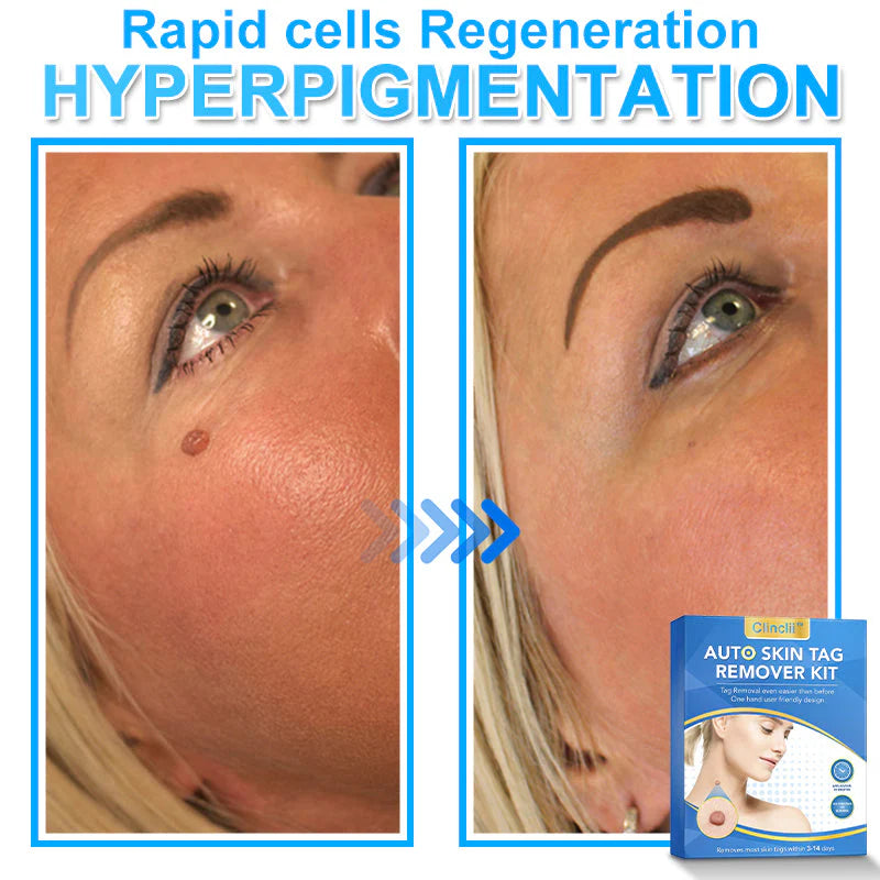 🔥MicroNeedle Botanic Skin Tag Removal kit 🇺🇸 Made in the USA👨‍⚕️