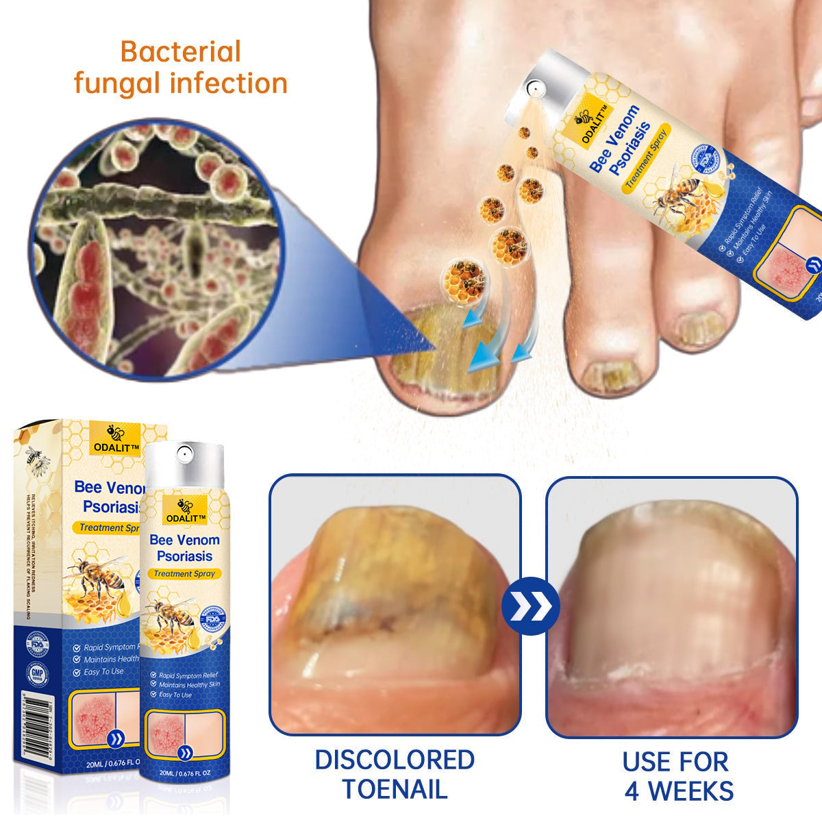 ODALIT™ PsoriaHeal Bee Venom Psoriasis Treatment Spray pro