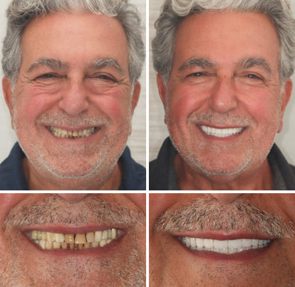 Custom-Fit Functional Dentures